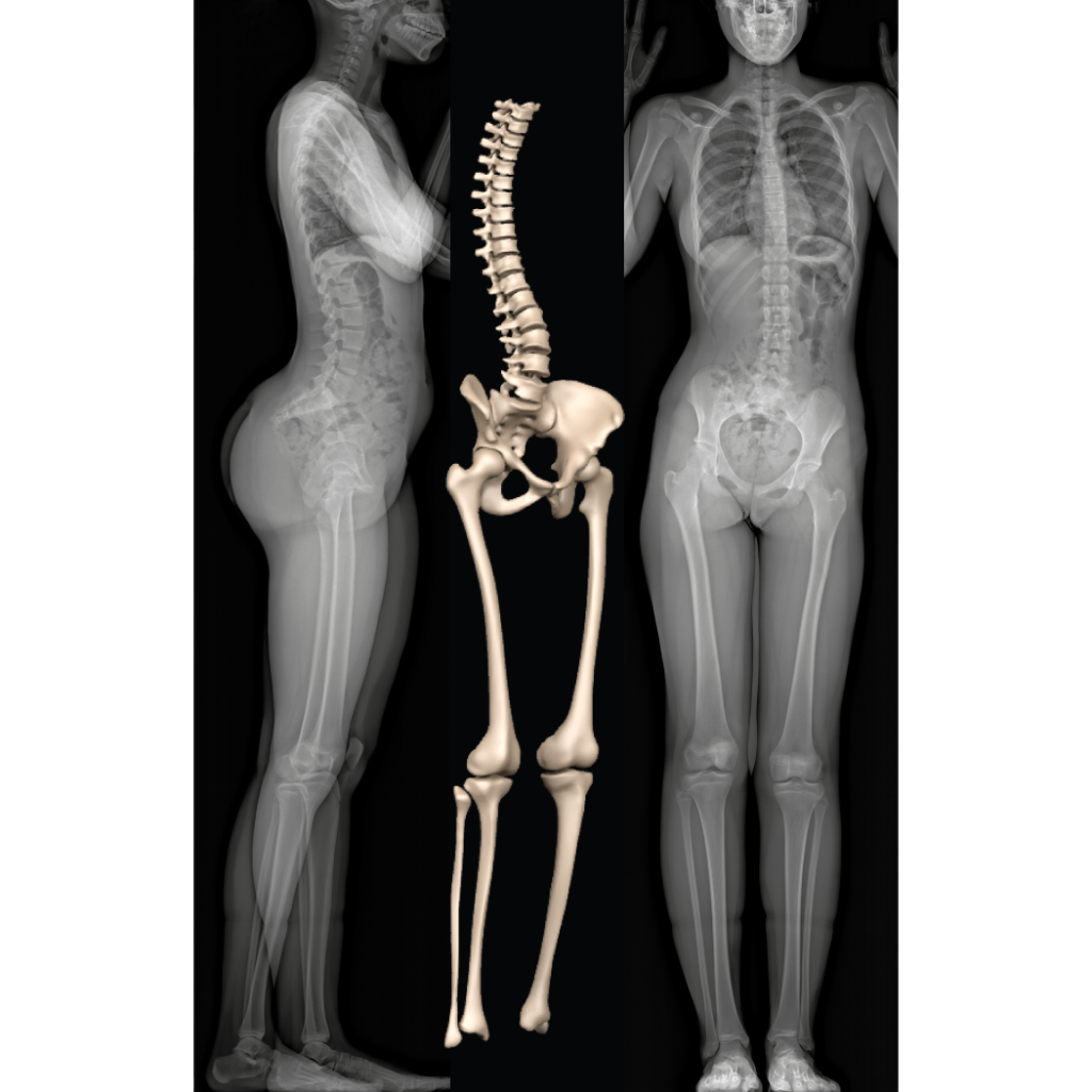 Radiographie corps entier EOS et 3D